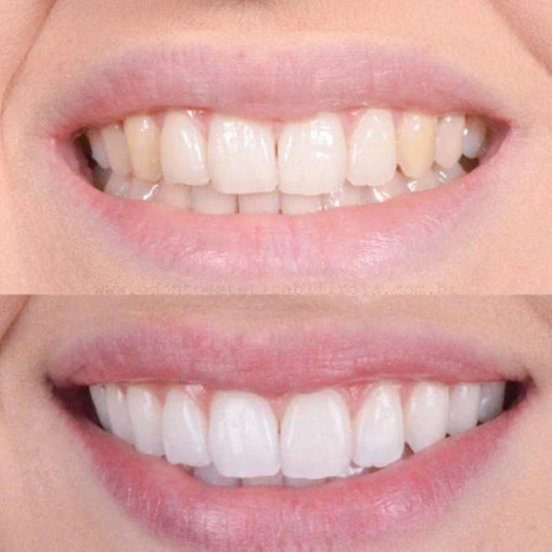 Blanqueamiento dental rápido para una sonrisa brillante 